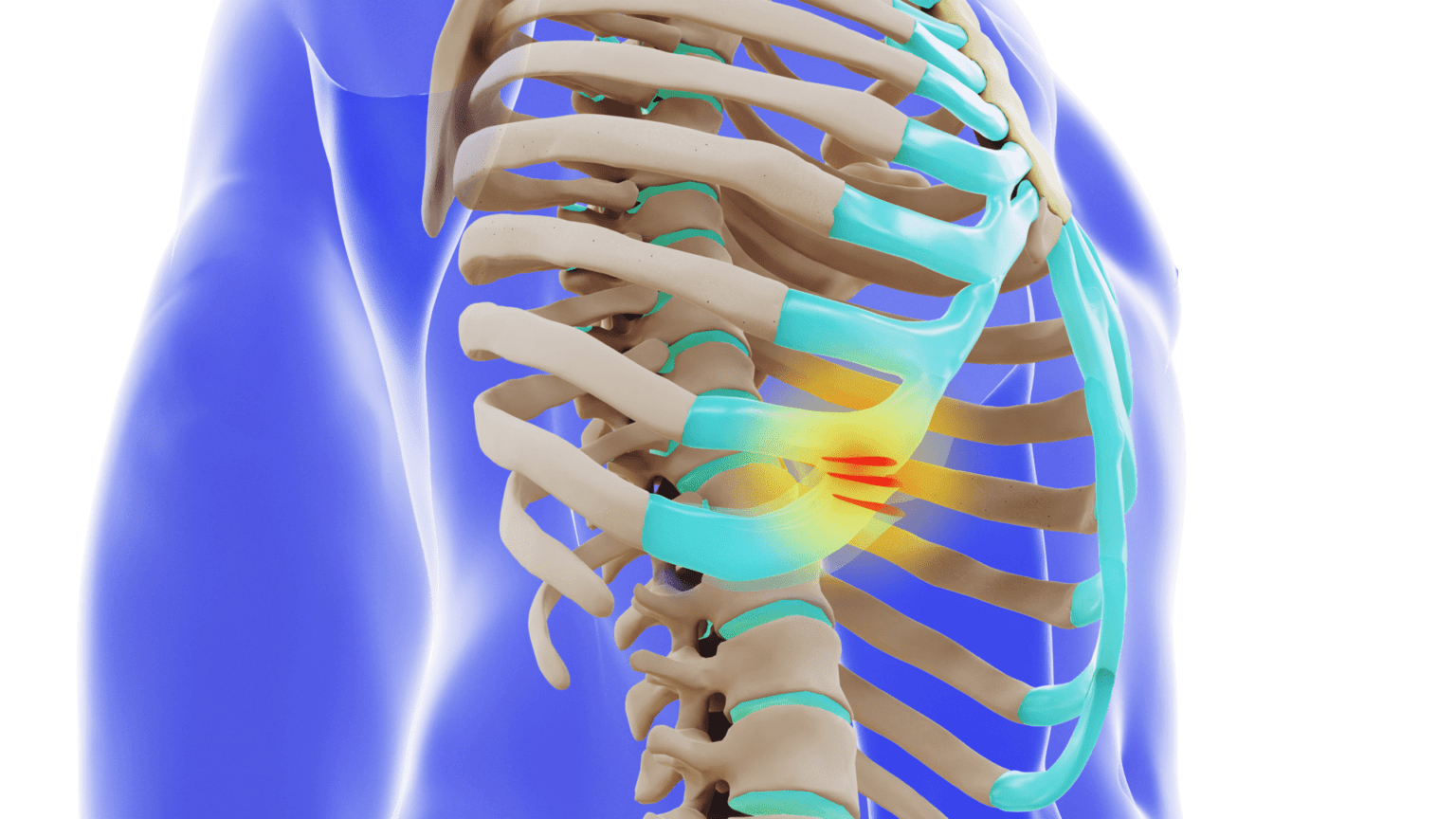What is SRS Slipping Rib Syndrome